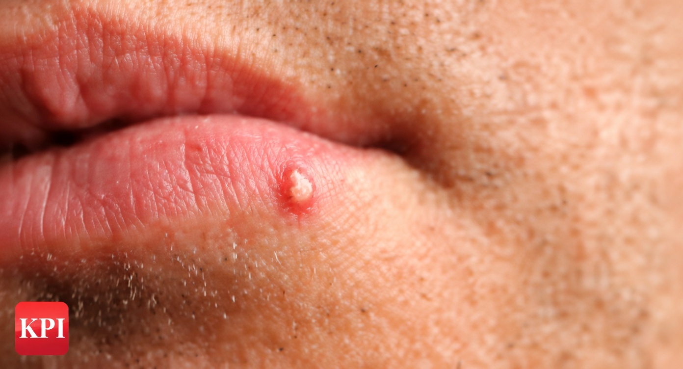 Mengapa Orang Menyadari Benjolan Putih Kecil yang Tidak Biasa di Bibir atau Bagian Pribadi Mereka: Panduan Sederhana