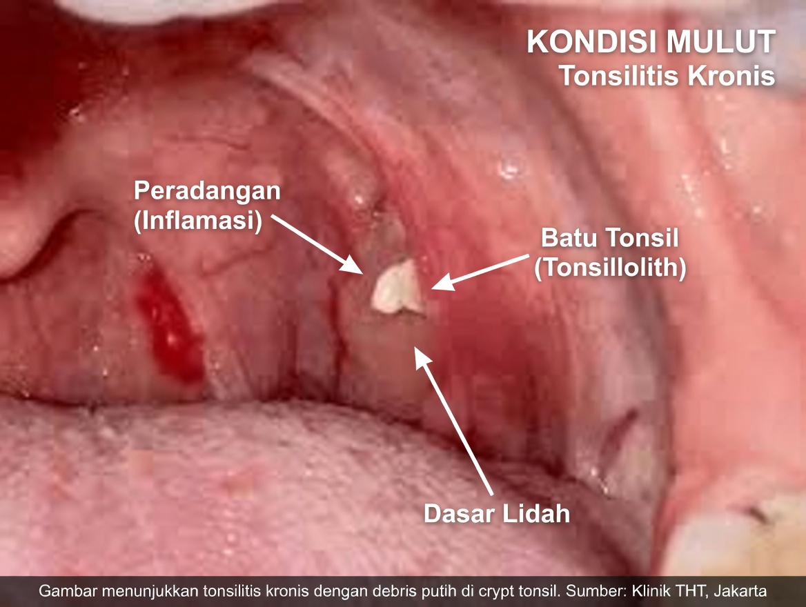Apa Benjolan Kecil yang Keluar dari Tenggorokan Anda Setelah Bersin? Memahami Batu Amandel