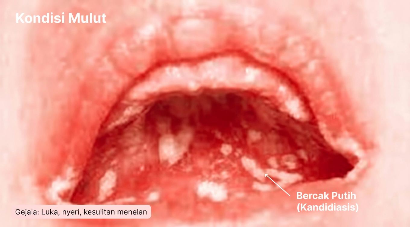 Cari Tahu Apa Arti Benjolan Putih di Mulut Anda dan Kebiasaan Harian yang Layak Dicoba
