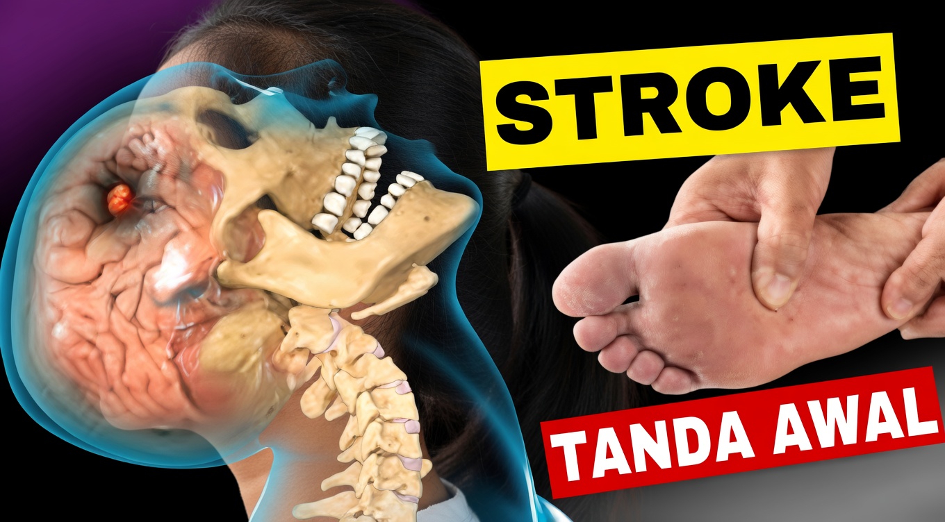 8 Tanda Peringatan Halus yang Bisa Menandakan Risiko Stroke Satu Bulan Sebelumnya + 9 Tips Praktis untuk Menurunkan Risikonya