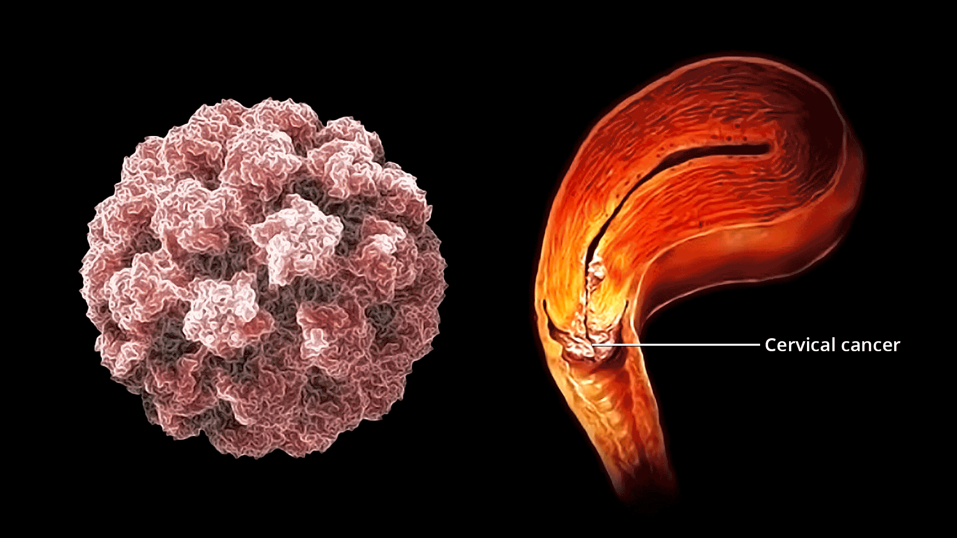 Gejala Kritis Kanker Serviks yang Harus Diketahui dan Jangan Pernah Diabaikan oleh Setiap Wanita