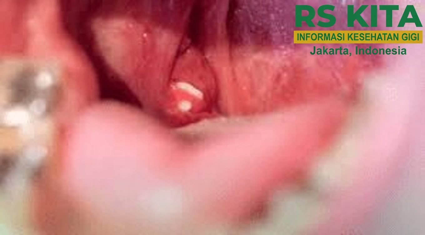 Batu Amandel: Apa Itu dan Mengapa Bisa Menjadi Penyebab Bau Mulut Anda yang Terus-Menerus