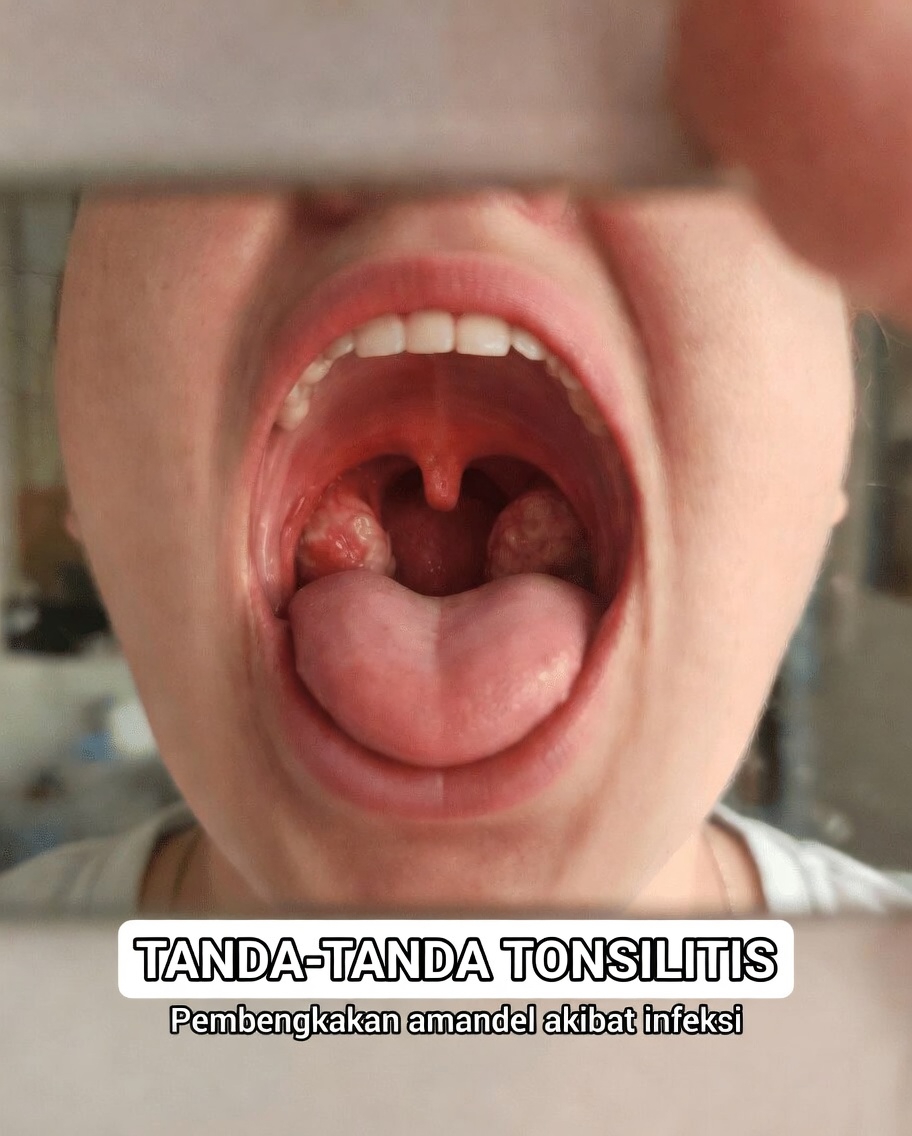 Apa Saja Berbagai Jenis Infeksi Tenggorokan dan Bagaimana Anda Dapat Mengenali Tanda-Tandanya Sejak Dini?