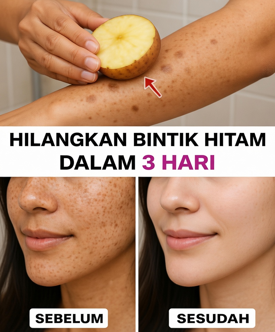 Hilangkan flek usia, melasma, bintik matahari, noda, dan tanda-tanda penuaan.