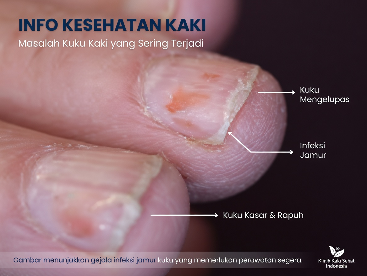 Mengapa Kuku Saya Terus Terbelah atau Patah? 10 Penyebab Umum dan Cara Sederhana untuk Membantunya Menjadi Lebih Kuat