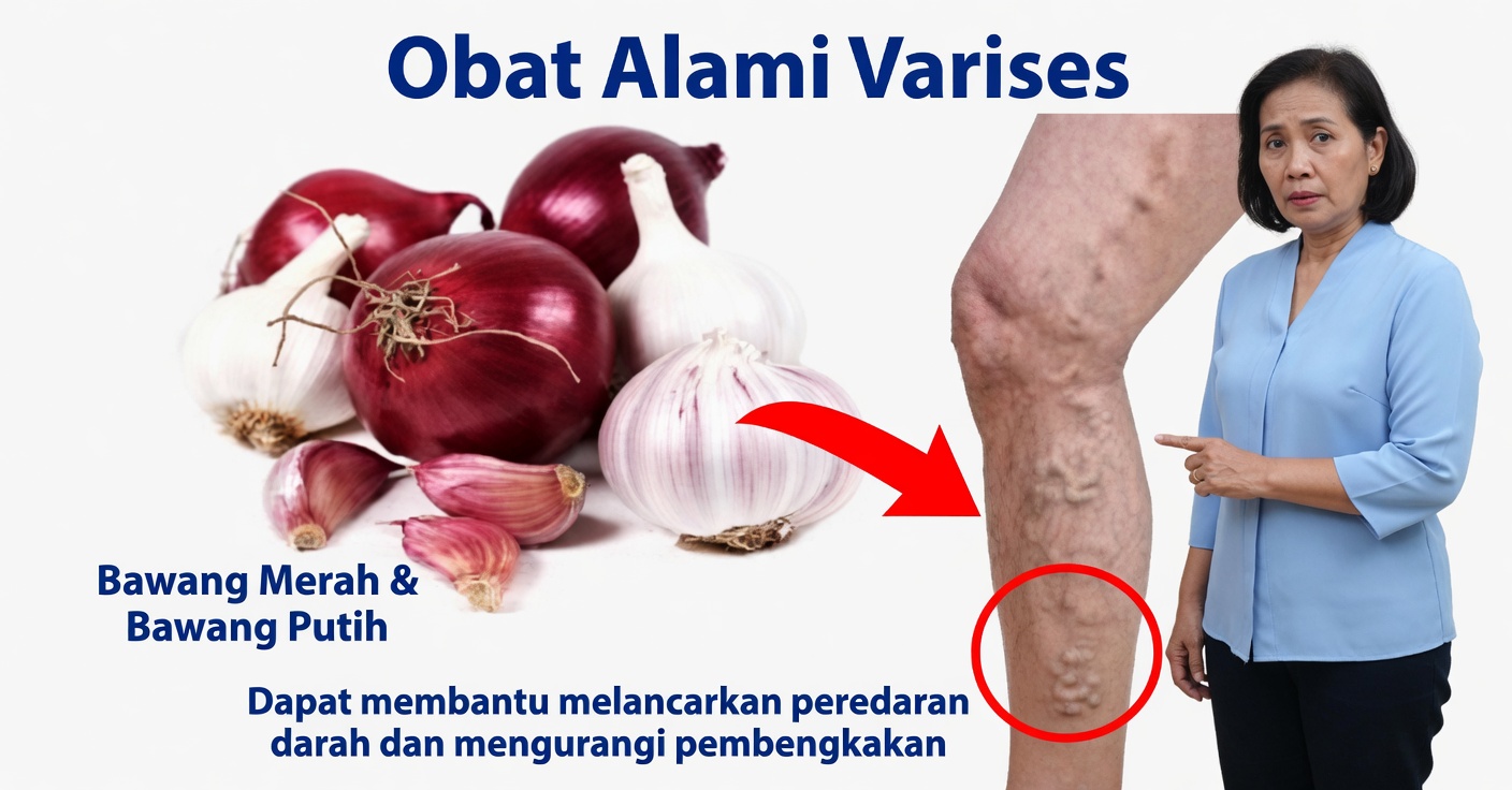 Obat Varises: Alami untuk Meningkatkan Sirkulasi