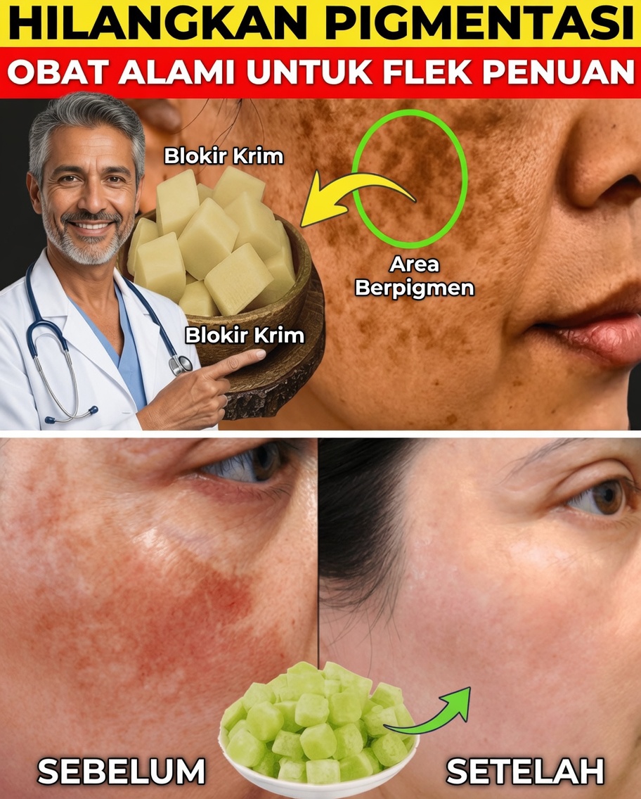 Hilangkan Pigmentasi, Melasma & Noda Hitam Secara Alami dalam 20 Hari – Ritual Lembut untuk Kulit Bercahaya