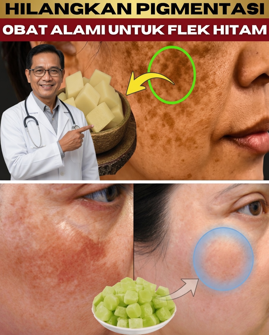 Hapus Pigmentasi, Melasma & Bintik Hitam Secara Alami Hanya dalam 20 Hari – Terinspirasi oleh Kearifan Umur Panjang Jepang