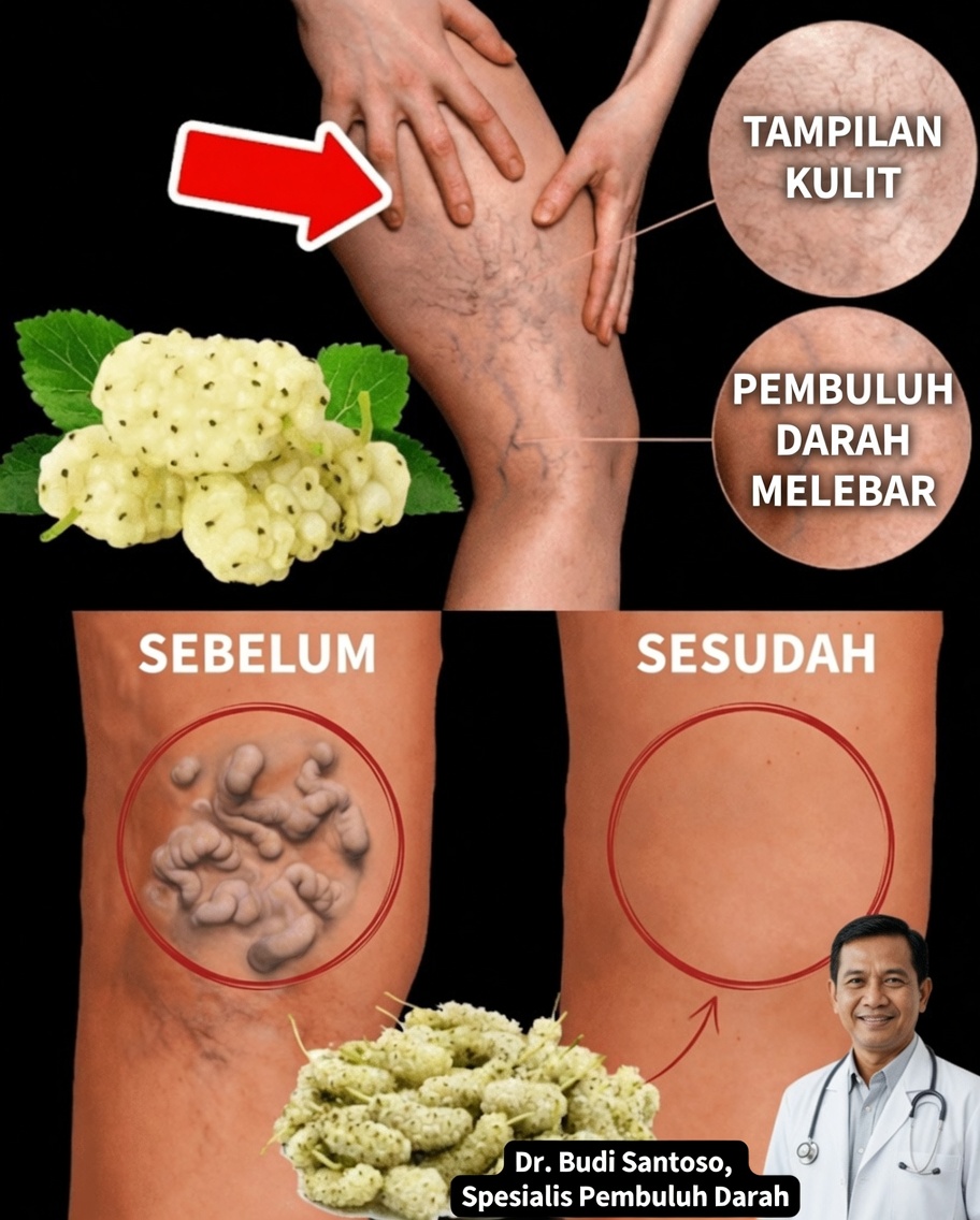 Jalur Alami Menuju Kaki yang Lebih Sehat: 15 Cara untuk Membantu Meredakan Varises