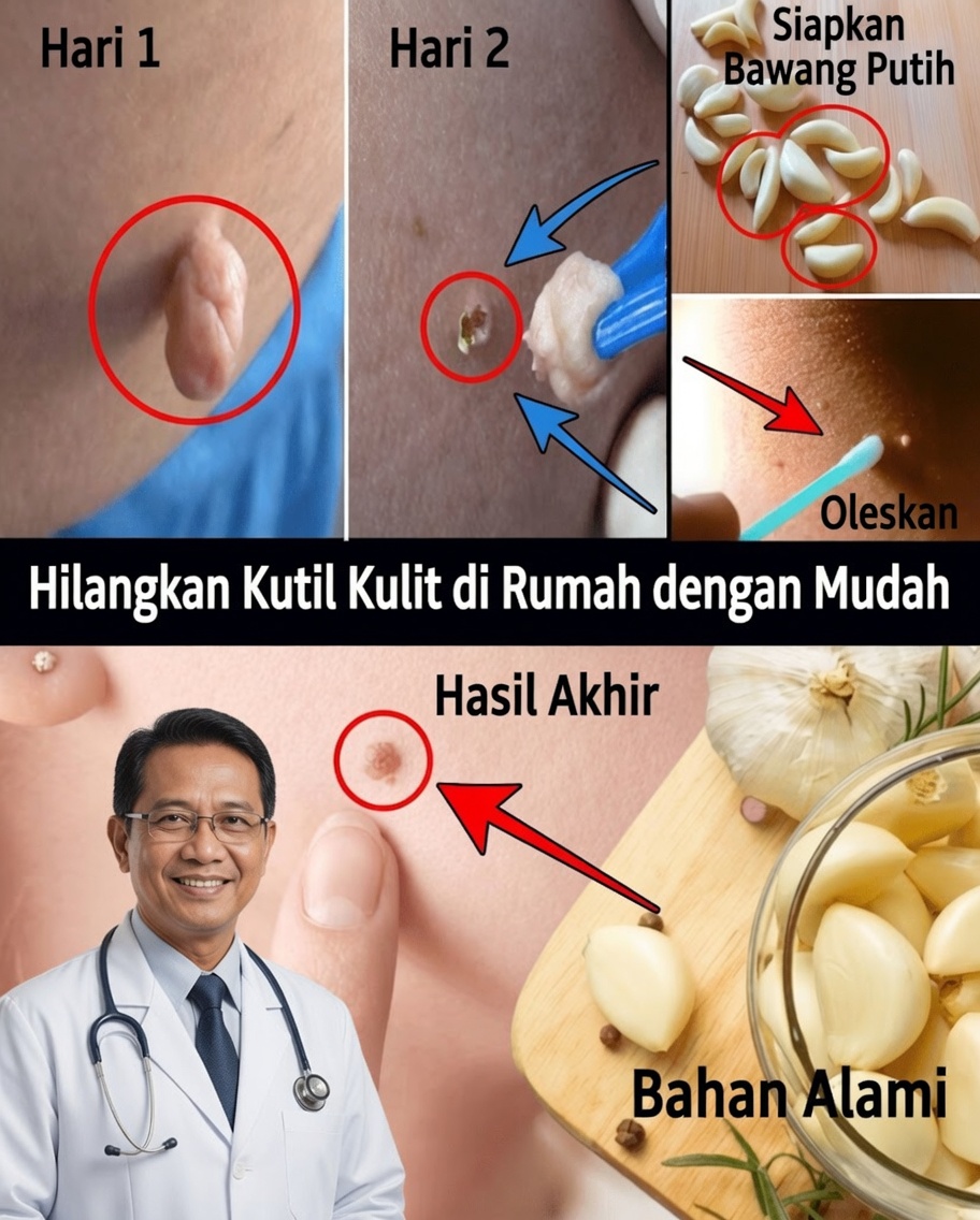 Cara Menghilangkan Kutil Daging Secara Alami dengan Vaseline: Metode Sederhana Semalaman