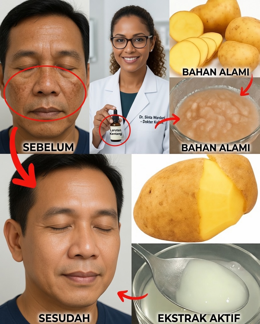 Trik Gel Kentang yang Dapat Membantu Mencerahkan Noda Hitam Secara Alami
